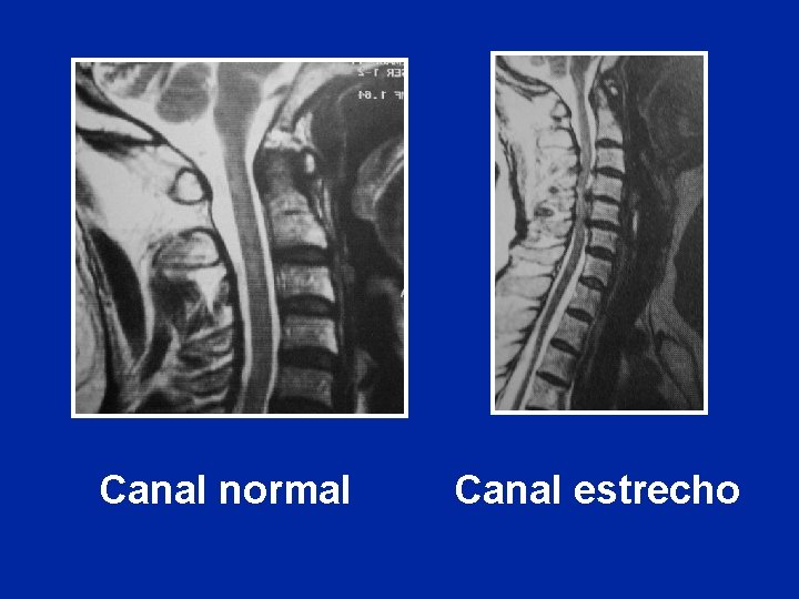 Canal normal Canal estrecho 