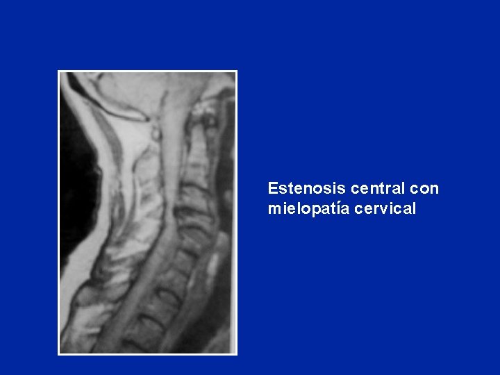 Estenosis central con mielopatía cervical 
