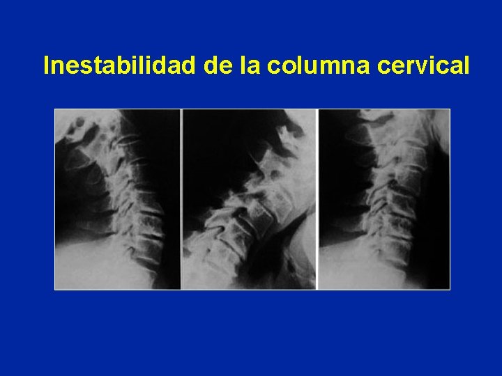 Inestabilidad de la columna cervical 
