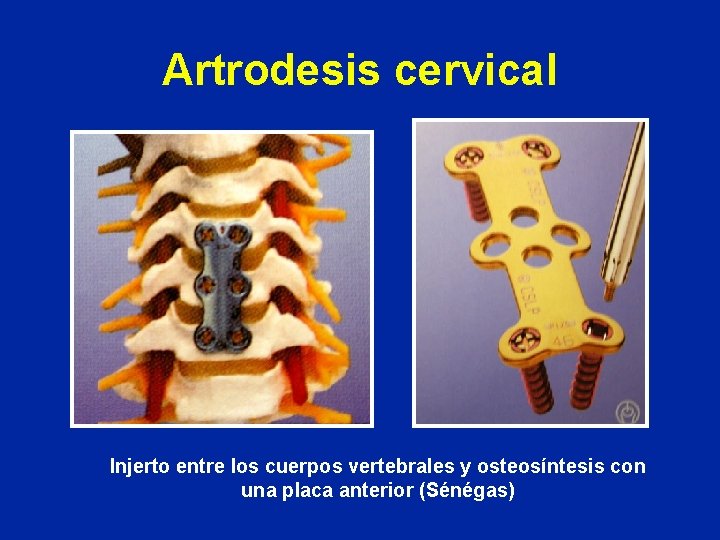 Artrodesis cervical Injerto entre los cuerpos vertebrales y osteosíntesis con una placa anterior (Sénégas)