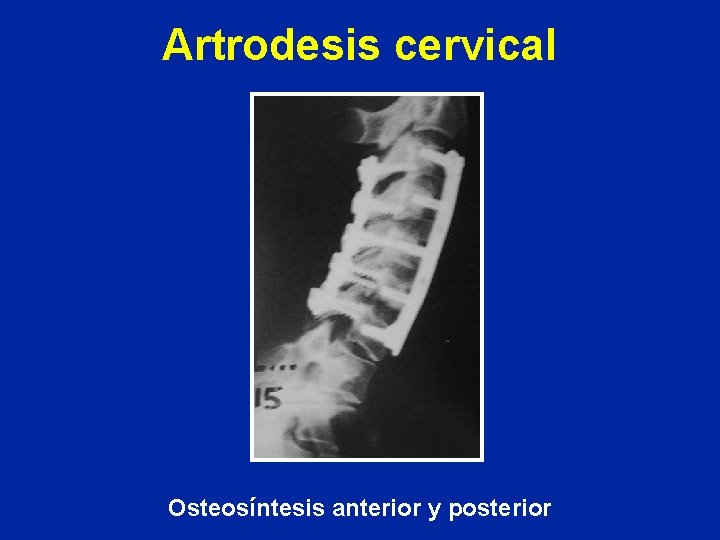 Artrodesis cervical Osteosíntesis anterior y posterior 