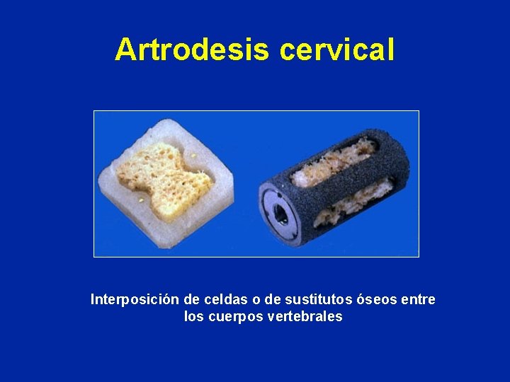Artrodesis cervical Interposición de celdas o de sustitutos óseos entre los cuerpos vertebrales 