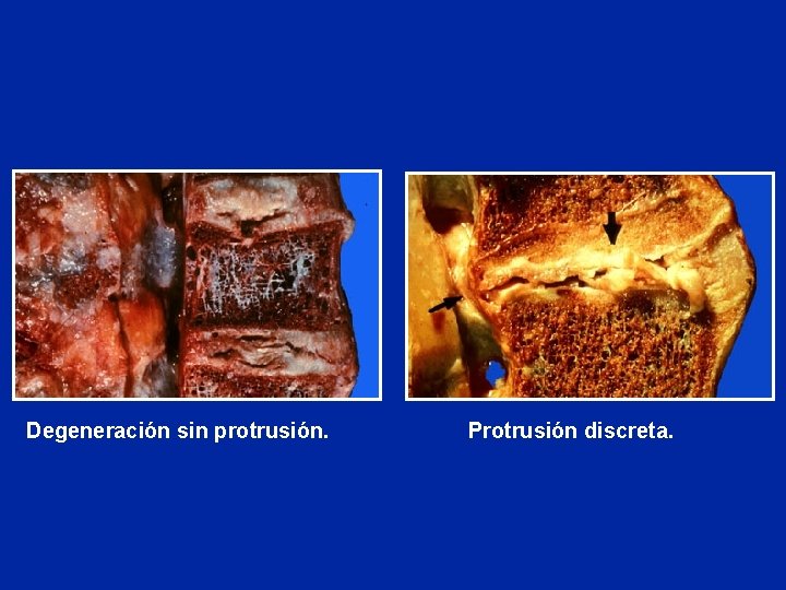 Degeneración sin protrusión. Protrusión discreta. 