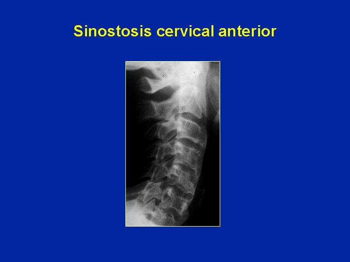 Sinostosis cervical anterior 
