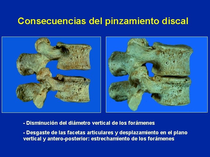 Consecuencias del pinzamiento discal - Disminución del diámetro vertical de los forámenes - Desgaste