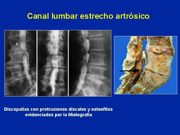 Canal lumbar estrecho artrósico Discopatías con protrusiones discales y osteofitos evidenciados por la Mielografía