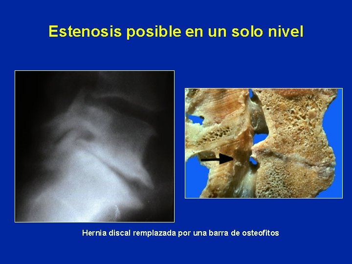 Estenosis posible en un solo nivel Hernia discal remplazada por una barra de osteofitos