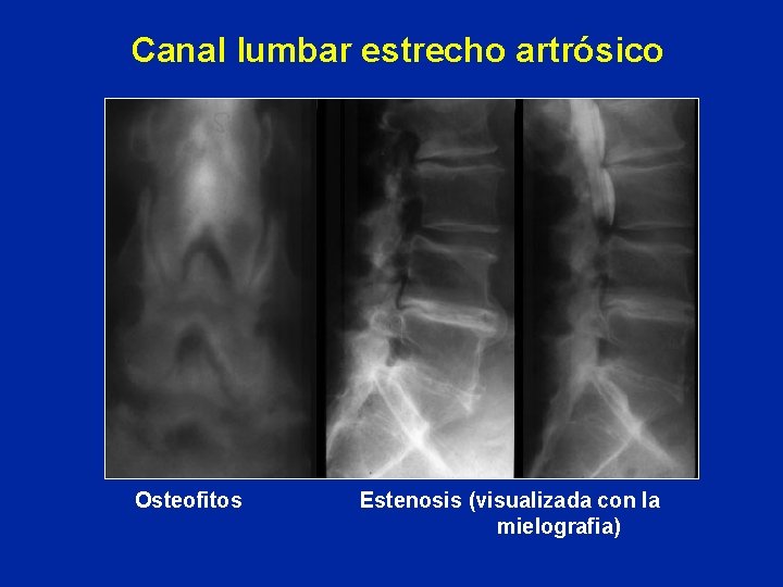 Canal lumbar estrecho artrósico Osteofitos Estenosis (visualizada con la mielografia) 