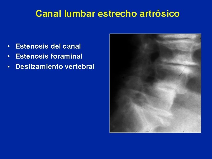 Canal lumbar estrecho artrósico • Estenosis del canal • Estenosis foraminal • Deslizamiento vertebral