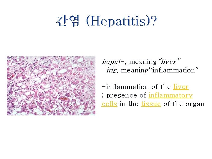 간염 (Hepatitis)? hepat-, meaning“liver” -itis, meaning“inflammation” -inflammation of the liver ; presence of inflammatory