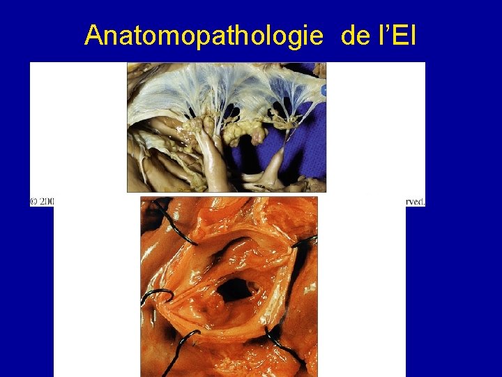 Anatomopathologie de l’EI 