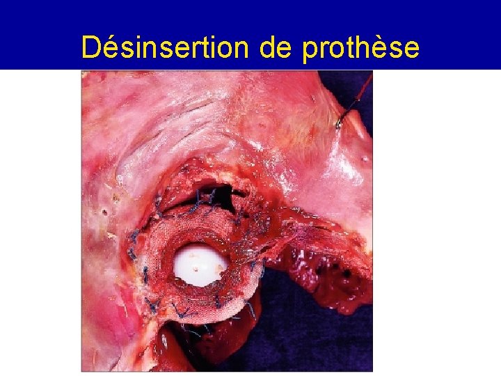 Désinsertion de prothèse 