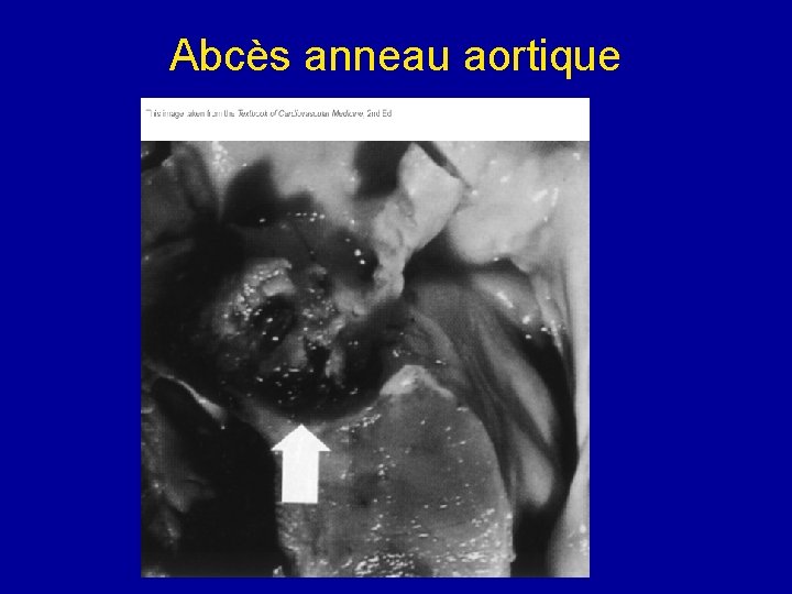 Abcès anneau aortique 