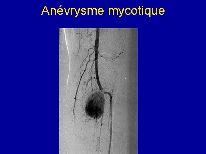 Anévrysme mycotique 