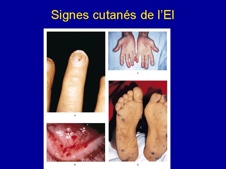 Signes cutanés de l’EI 