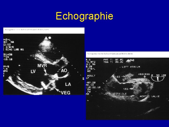 Echographie 