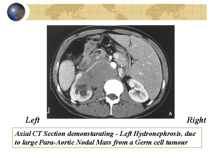 Left Right Axial CT Section demonstarating - Left Hydronephrosis, due to large Para-Aortic Nodal