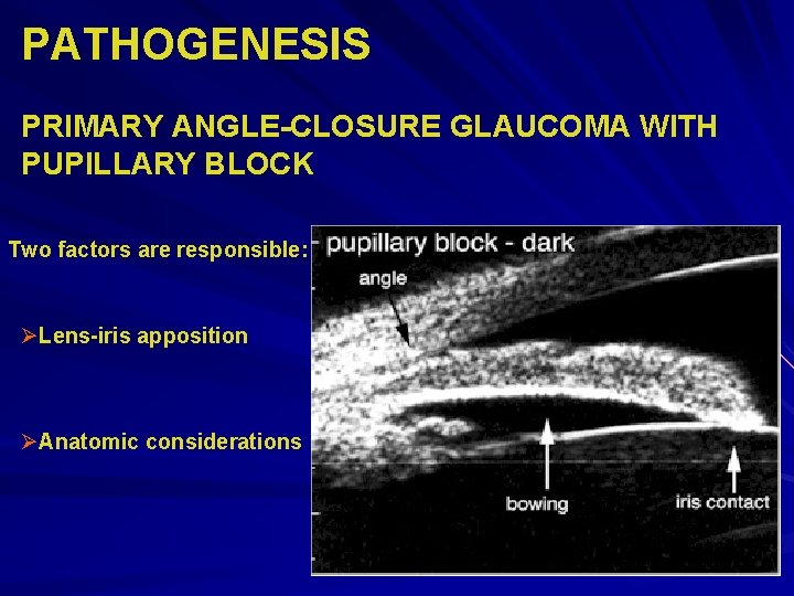 PATHOGENESIS PRIMARY ANGLE-CLOSURE GLAUCOMA WITH PUPILLARY BLOCK Two factors are responsible: ØLens-iris apposition ØAnatomic PATHOGENESIS PRIMARY ANGLE-CLOSURE GLAUCOMA WITH PUPILLARY BLOCK Two factors are responsible: ØLens-iris apposition ØAnatomic