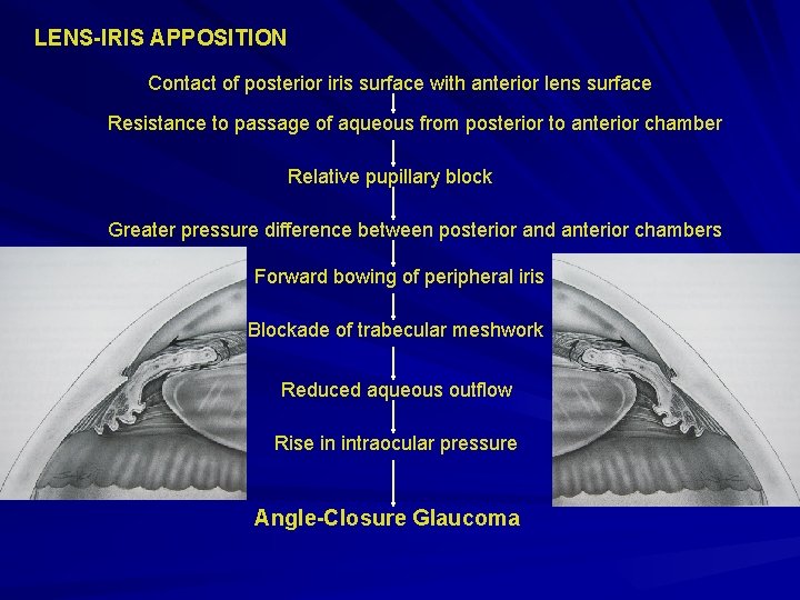 LENS-IRIS APPOSITION Contact of posterior iris surface with anterior lens surface Resistance to passage LENS-IRIS APPOSITION Contact of posterior iris surface with anterior lens surface Resistance to passage