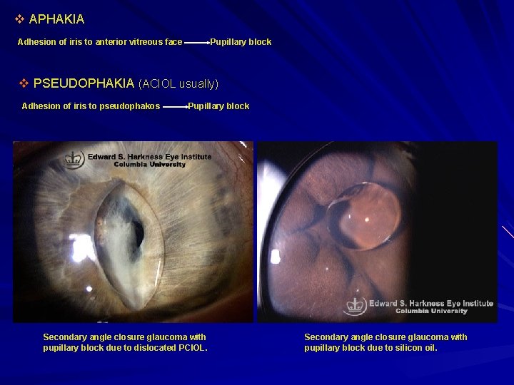 v APHAKIA Adhesion of iris to anterior vitreous face Pupillary block v PSEUDOPHAKIA (ACIOL v APHAKIA Adhesion of iris to anterior vitreous face Pupillary block v PSEUDOPHAKIA (ACIOL