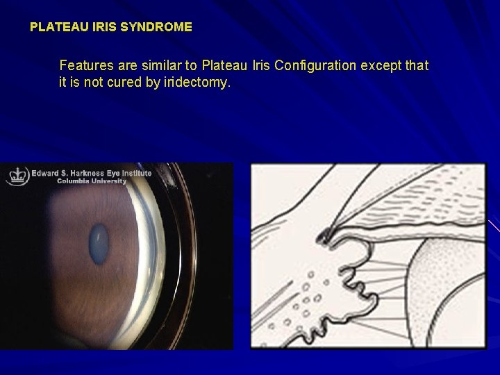 PLATEAU IRIS SYNDROME Features are similar to Plateau Iris Configuration except that it is PLATEAU IRIS SYNDROME Features are similar to Plateau Iris Configuration except that it is
