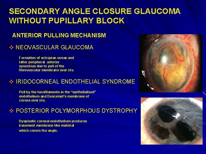 SECONDARY ANGLE CLOSURE GLAUCOMA WITHOUT PUPILLARY BLOCK ANTERIOR PULLING MECHANISM v NEOVASCULAR GLAUCOMA Formation SECONDARY ANGLE CLOSURE GLAUCOMA WITHOUT PUPILLARY BLOCK ANTERIOR PULLING MECHANISM v NEOVASCULAR GLAUCOMA Formation