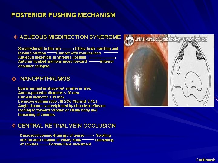 POSTERIOR PUSHING MECHANISM v AQUEOUS MISDIRECTION SYNDROME Surgery/Insult to the eye Ciliary body swelling POSTERIOR PUSHING MECHANISM v AQUEOUS MISDIRECTION SYNDROME Surgery/Insult to the eye Ciliary body swelling
