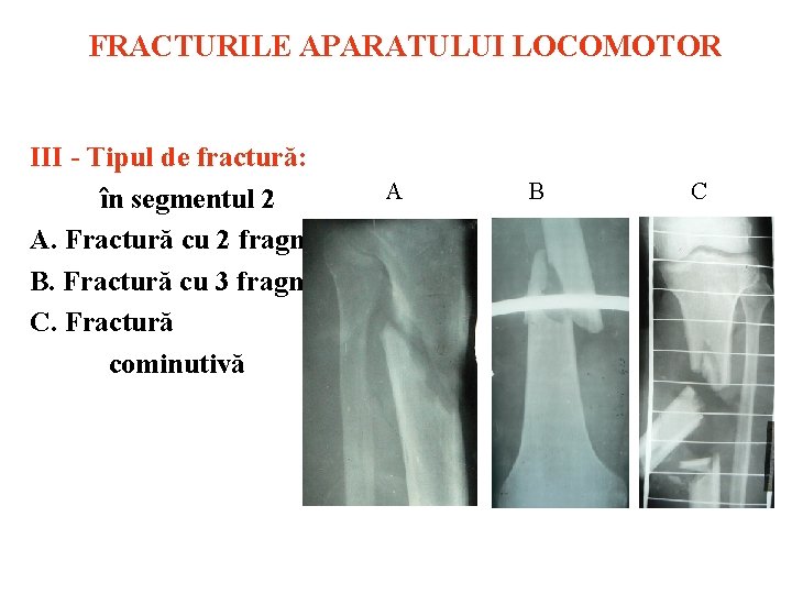 FRACTURILE APARATULUI LOCOMOTOR III Tipul de fractură: A în segmentul 2 A. Fractură cu