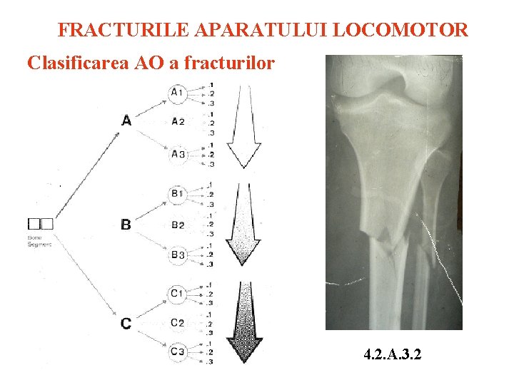 FRACTURILE APARATULUI LOCOMOTOR Clasificarea AO a fracturilor 4. 2. A. 3. 2 