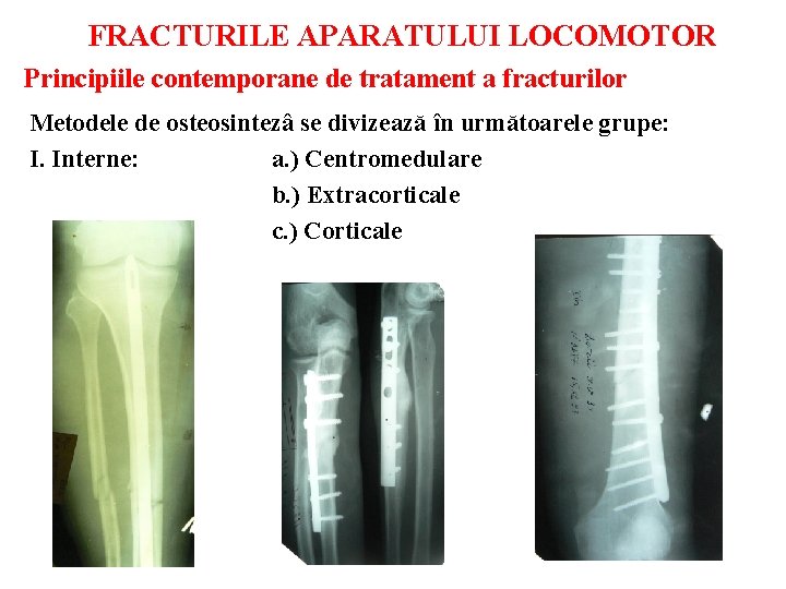 FRACTURILE APARATULUI LOCOMOTOR Principiile contemporane de tratament a fracturilor Metodele de osteosintezâ se divizează