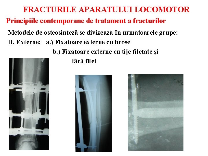 FRACTURILE APARATULUI LOCOMOTOR Principiile contemporane de tratament a fracturilor Metodele de osteosintezâ se divizează