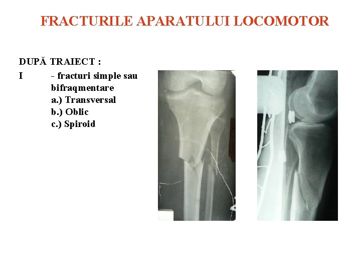FRACTURILE APARATULUI LOCOMOTOR DUPĂ TRAIECT : I fracturi simple sau bifraqmentare a. ) Transversal