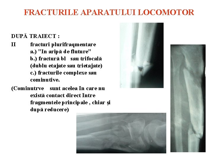 FRACTURILE APARATULUI LOCOMOTOR DUPĂ TRAIECT : II fracturi plurifraqmentare a. ) "In aripă de