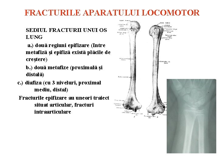 FRACTURILE APARATULUI LOCOMOTOR SEDIUL FRACTURII UNUI OS LUNG a. ) două regiuni epifizare (Intre