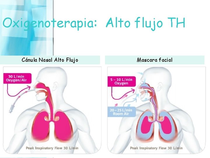 Oxigenoterapia: Alto flujo TH Cánula Nasal Alto Flujo Mascara facial 