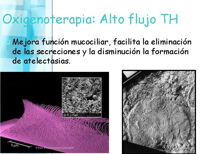 Oxigenoterapia: Alto flujo TH q Mejora función mucociliar, facilita la eliminación de las secreciones