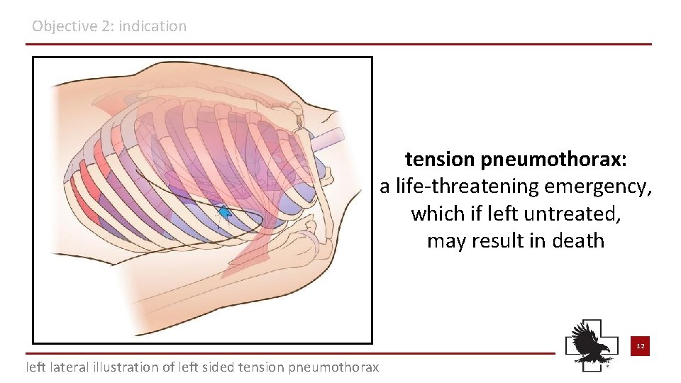 Objective 2: indication tension pneumothorax: a life-threatening emergency, which if left untreated, may result Objective 2: indication tension pneumothorax: a life-threatening emergency, which if left untreated, may result