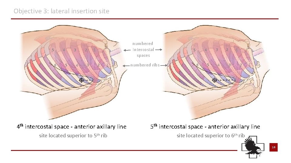 Objective 3: lateral insertion site 5 4 6 3 5 4 2 3 numbered Objective 3: lateral insertion site 5 4 6 3 5 4 2 3 numbered