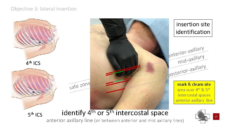 Objective 3: lateral insertion site identification y r a l l i x -a Objective 3: lateral insertion site identification y r a l l i x -a