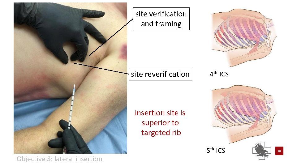 site verification and framing site reverification 4 th ICS insertion site is superior to site verification and framing site reverification 4 th ICS insertion site is superior to