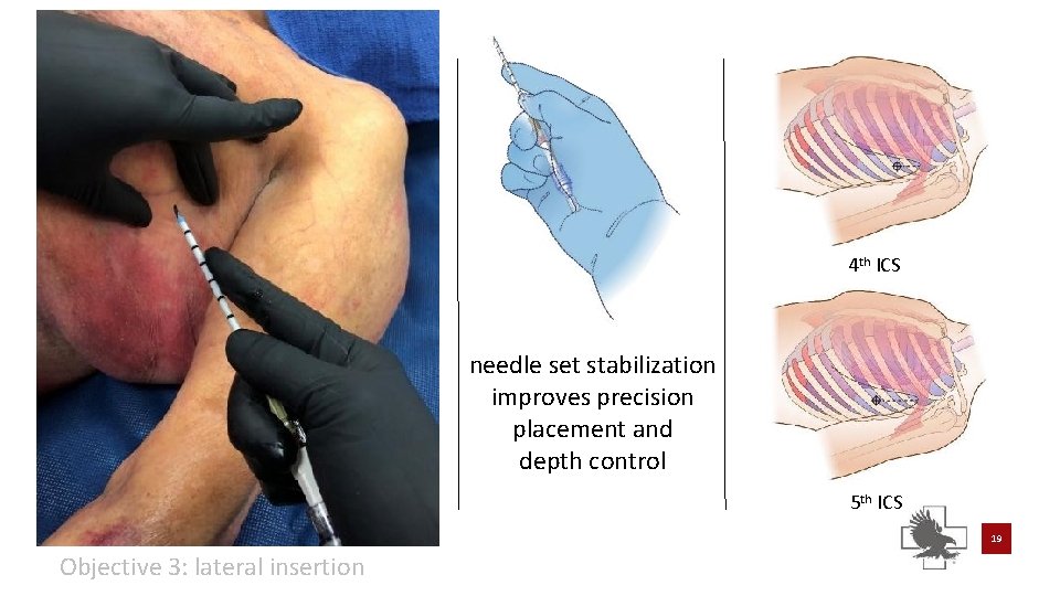 4 th ICS needle set stabilization improves precision placement and depth control 5 th 4 th ICS needle set stabilization improves precision placement and depth control 5 th