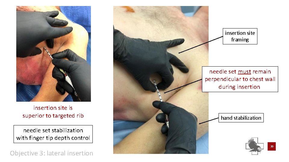 insertion site framing needle set must remain perpendicular to chest wall during insertion site insertion site framing needle set must remain perpendicular to chest wall during insertion site