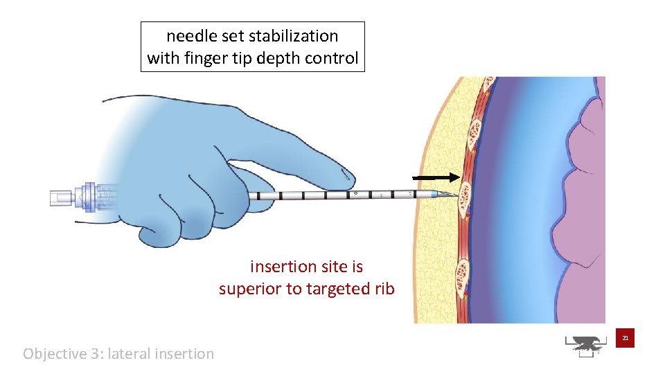 needle set stabilization with finger tip depth control insertion site is superior to targeted needle set stabilization with finger tip depth control insertion site is superior to targeted
