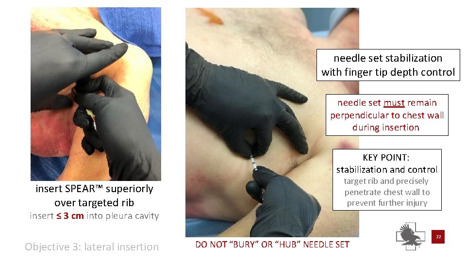 needle set stabilization with finger tip depth control needle set must remain perpendicular to needle set stabilization with finger tip depth control needle set must remain perpendicular to