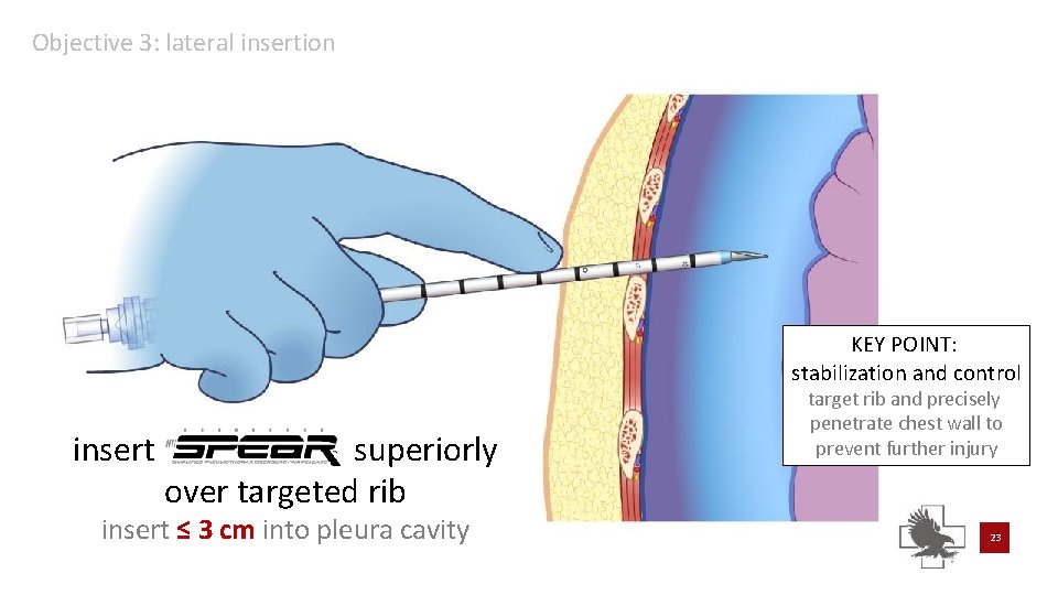 Objective 3: lateral insertion KEY POINT: stabilization and control insert superiorly over targeted rib Objective 3: lateral insertion KEY POINT: stabilization and control insert superiorly over targeted rib