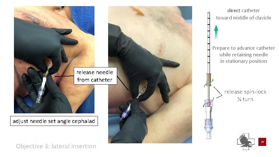 direct catheter toward middle of clavicle Prepare to advance catheter while retaining needle in direct catheter toward middle of clavicle Prepare to advance catheter while retaining needle in