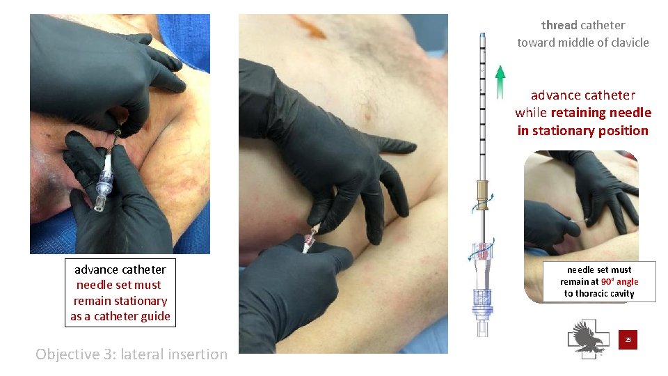 thread catheter toward middle of clavicle advance catheter while retaining needle in stationary position thread catheter toward middle of clavicle advance catheter while retaining needle in stationary position
