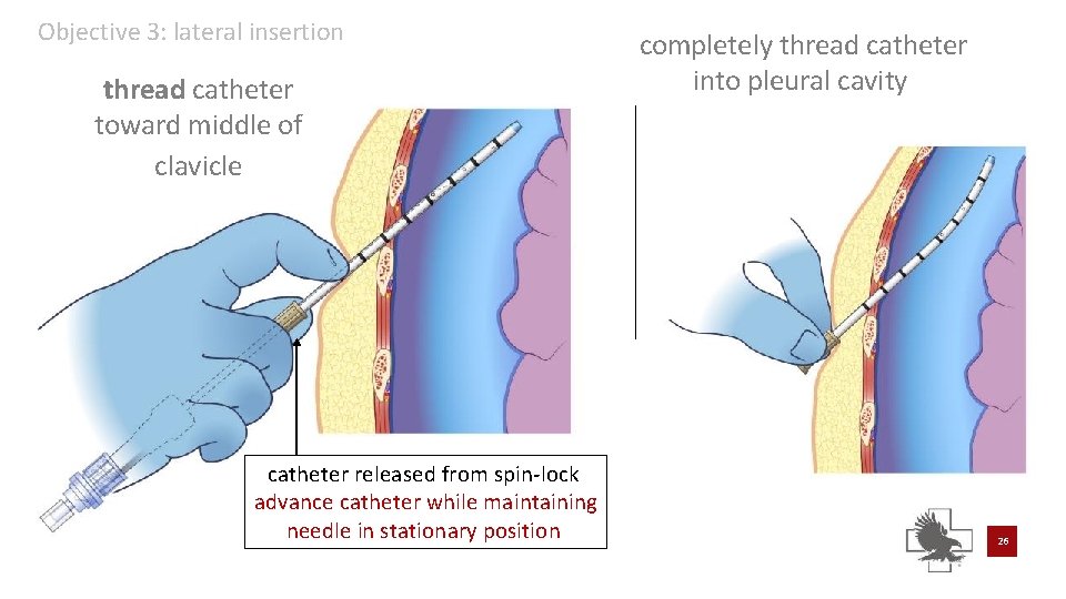 Objective 3: lateral insertion thread catheter toward middle of clavicle catheter released from spin-lock Objective 3: lateral insertion thread catheter toward middle of clavicle catheter released from spin-lock