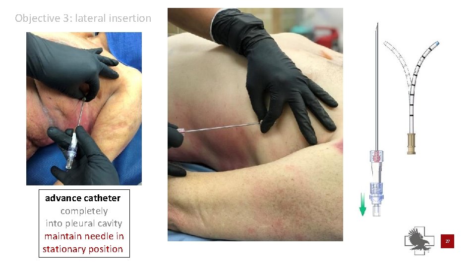 Objective 3: lateral insertion advance catheter completely into pleural cavity maintain needle in stationary Objective 3: lateral insertion advance catheter completely into pleural cavity maintain needle in stationary