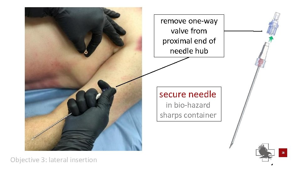 remove one-way valve from proximal end of needle hub secure needle in bio-hazard sharps remove one-way valve from proximal end of needle hub secure needle in bio-hazard sharps